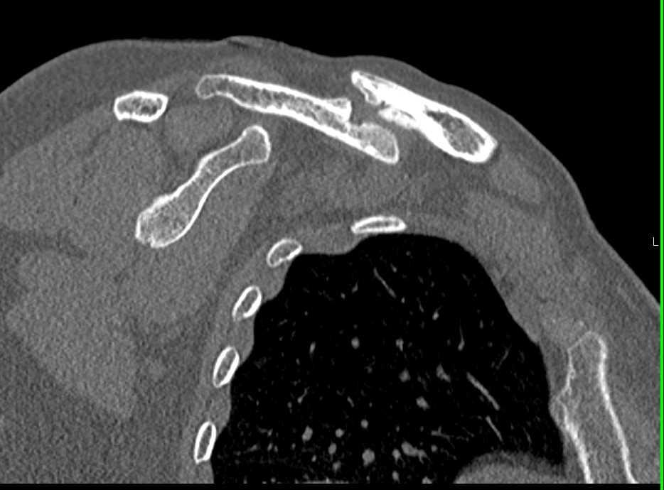 Non Union of Clavicular Fracture - CTisus CT Scan