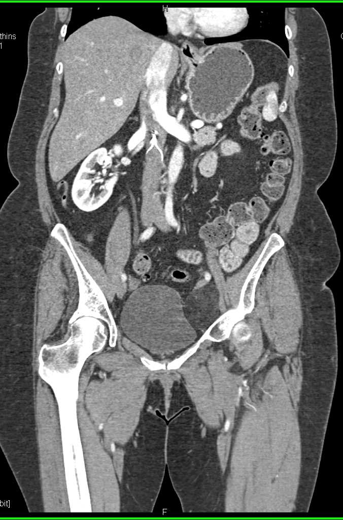 Liposarcoma Left Inguinal Zone - CTisus CT Scan