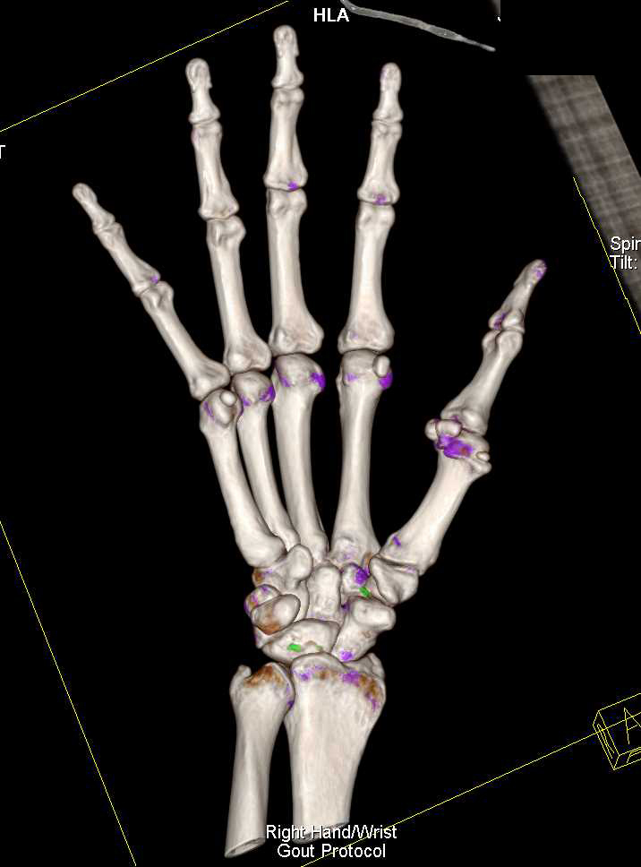 Dual Energy CT of the Wrist and Gout - CTisus CT Scan