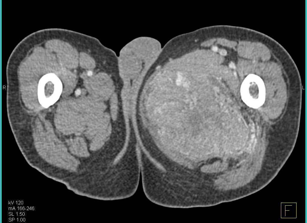 Sarcoma Left Thigh with Neovascularity - CTisus CT Scan