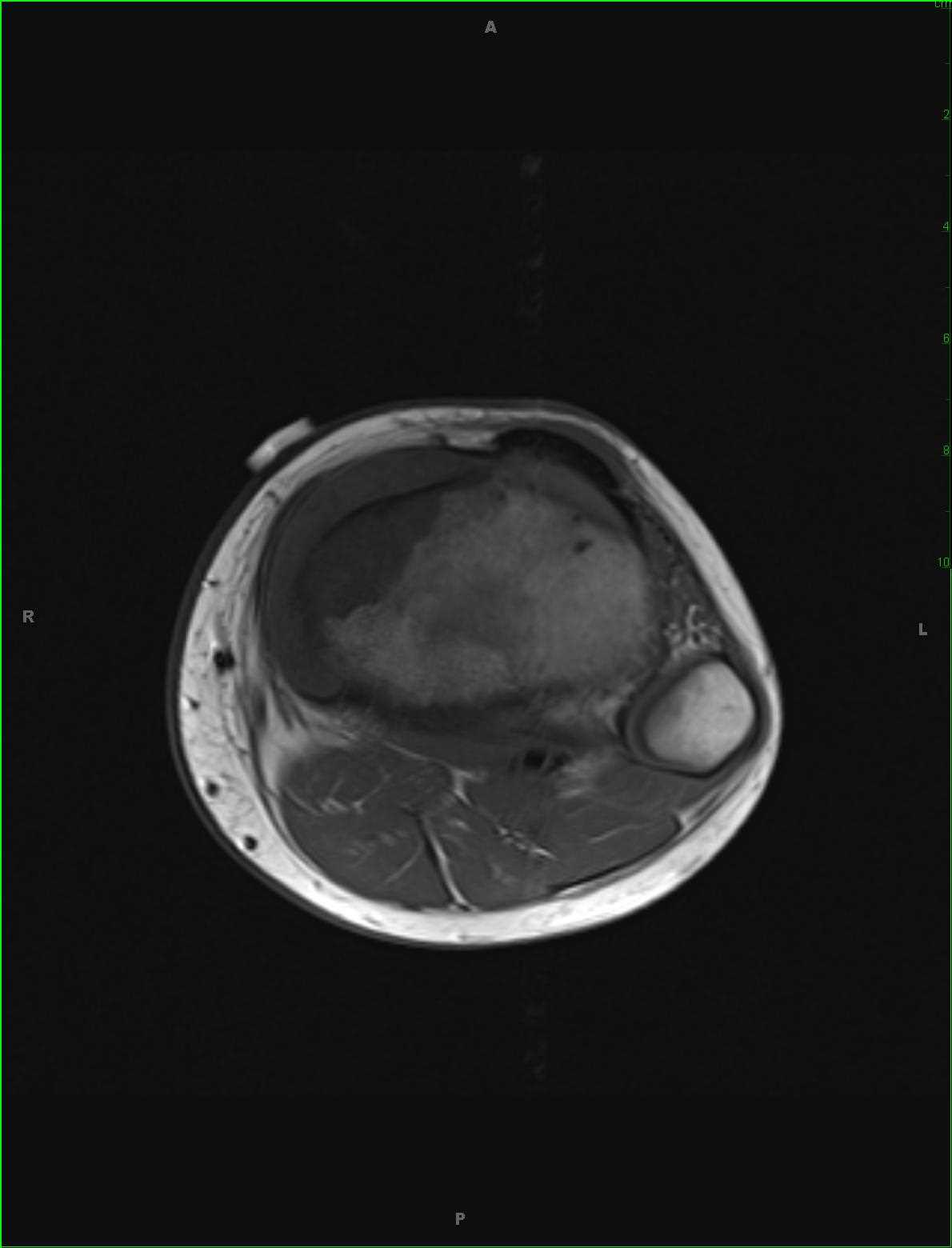 Periosteal Osteosarcoma Tibia - CTisus CT Scan