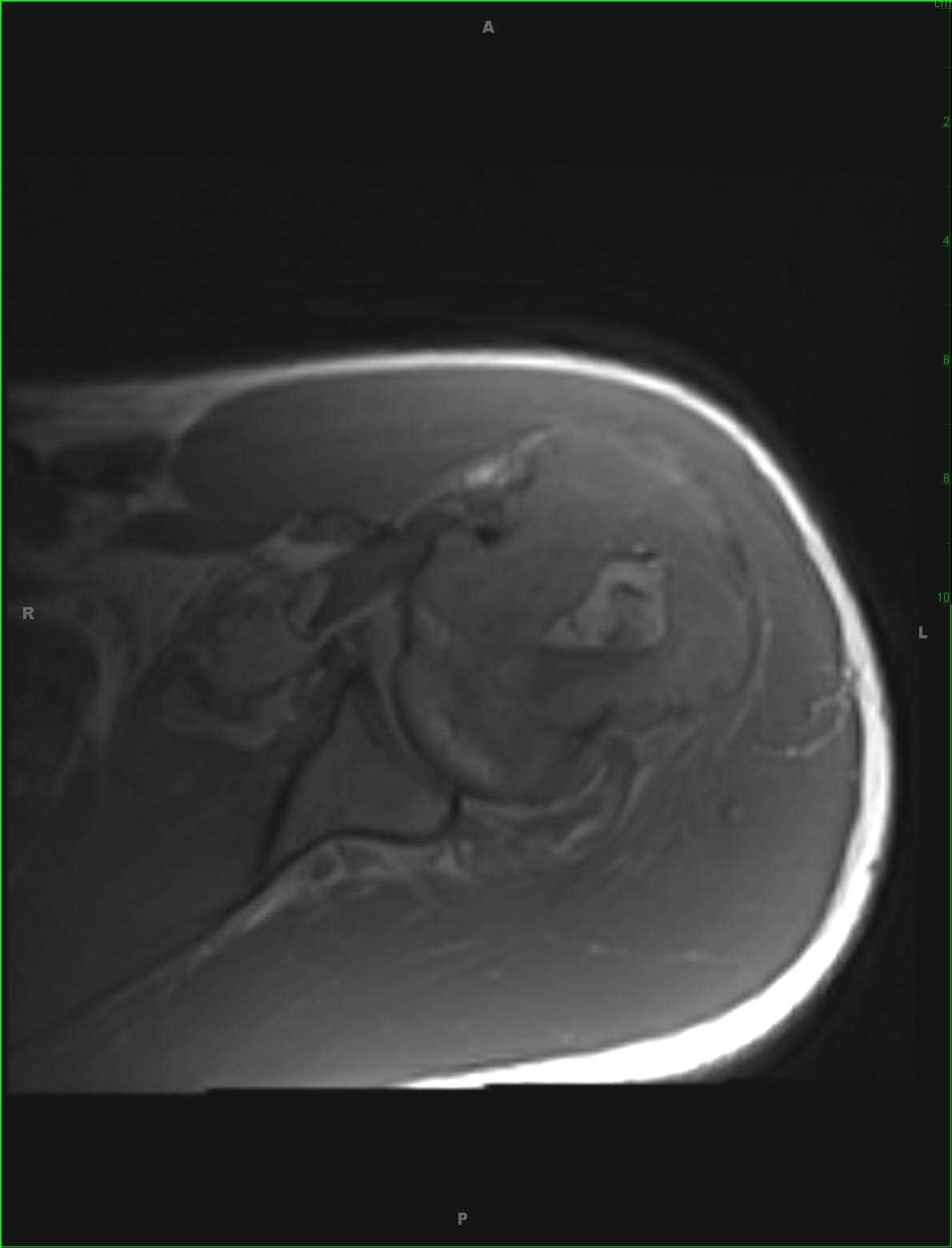 Giant Cell Tumor Humerus - CTisus CT Scan