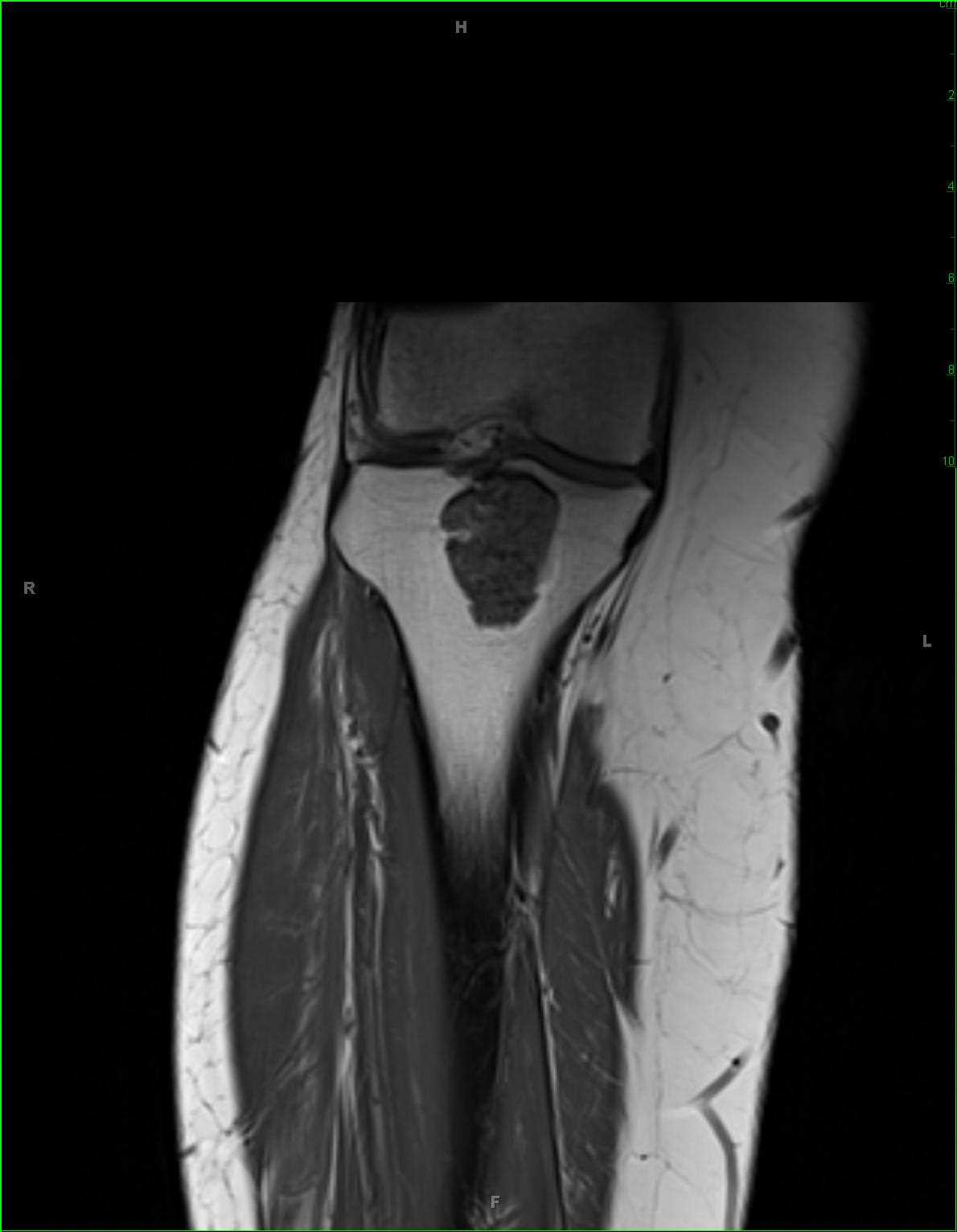 Enchondroma Tibia - CTisus CT Scan