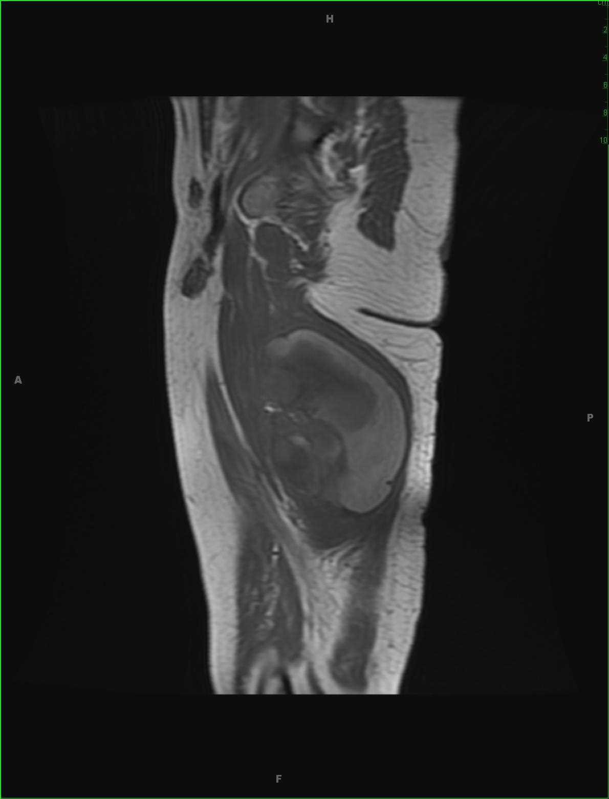 Synovial Sarcoma Thigh - CTisus CT Scan