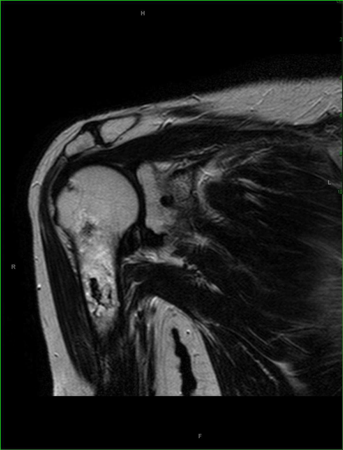 Bone Infarct Humerus - CTisus CT Scan