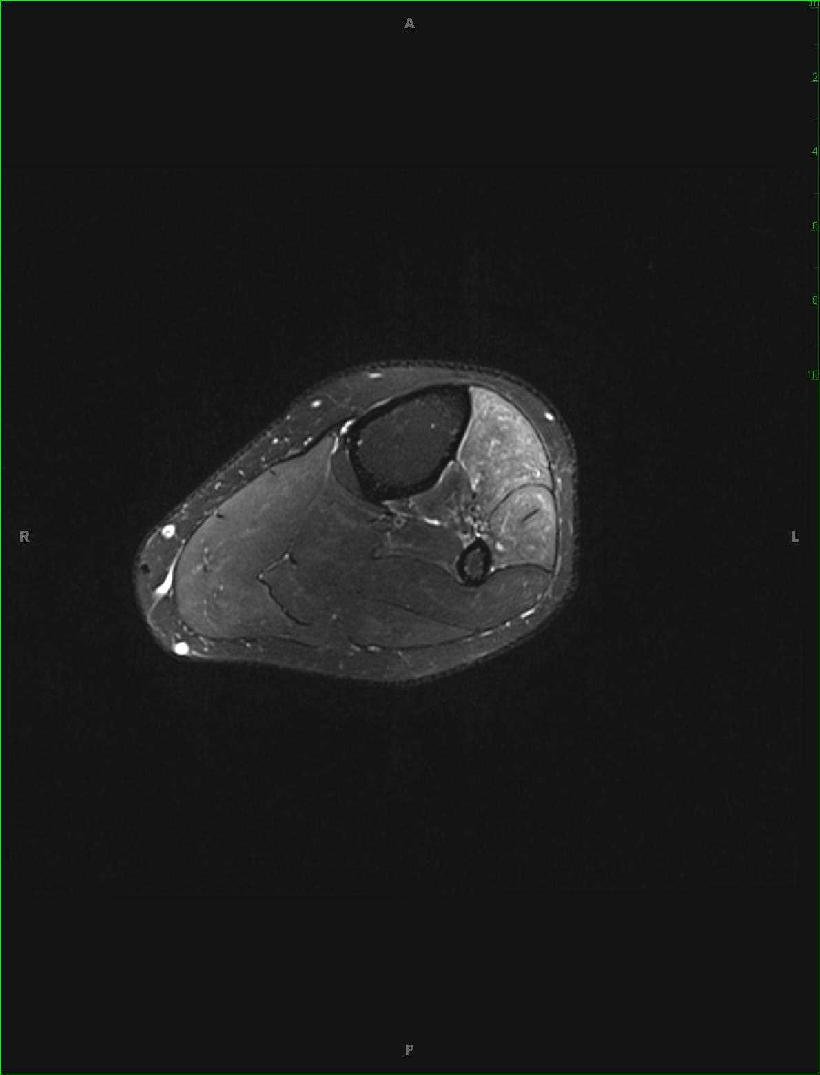 Common Peroneal Neuroma - CTisus CT Scan