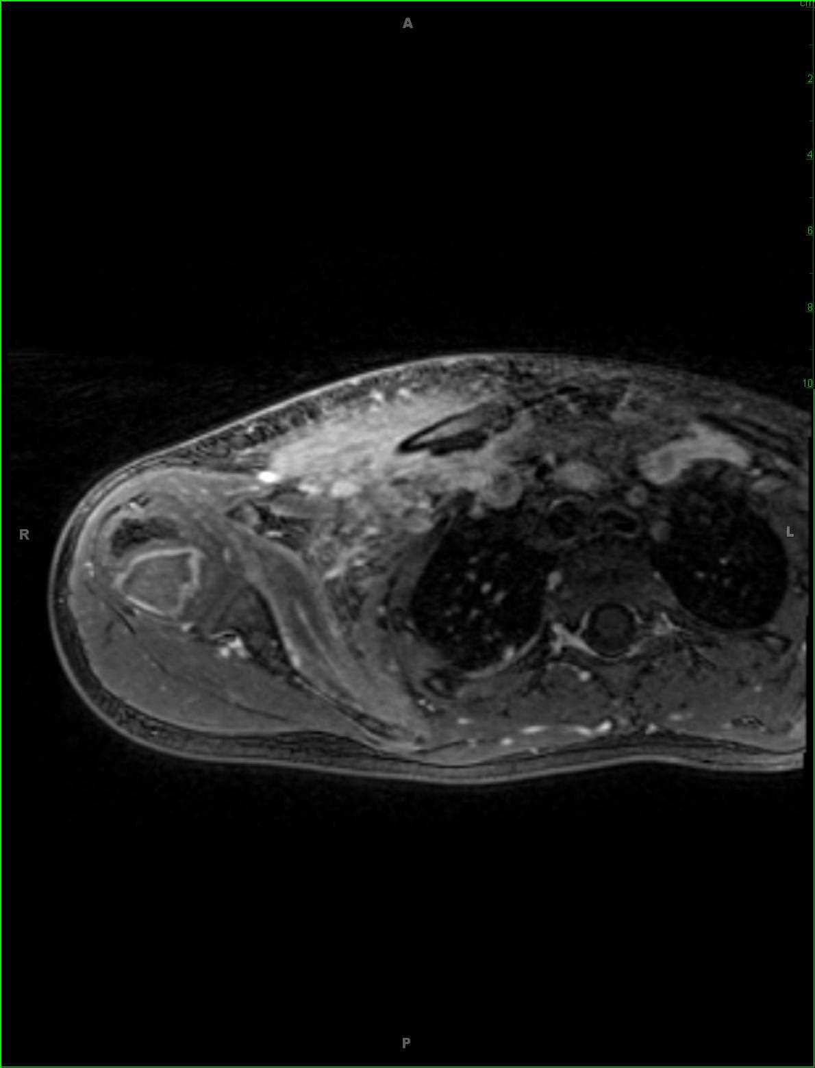 Right Clavicle Osteomyelitis and Subperiosteal Abscess - CTisus CT Scan