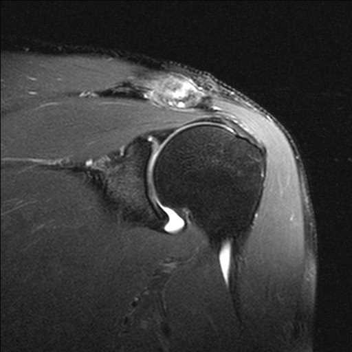 Type 2 SLAP Tear - CTisus CT Scan