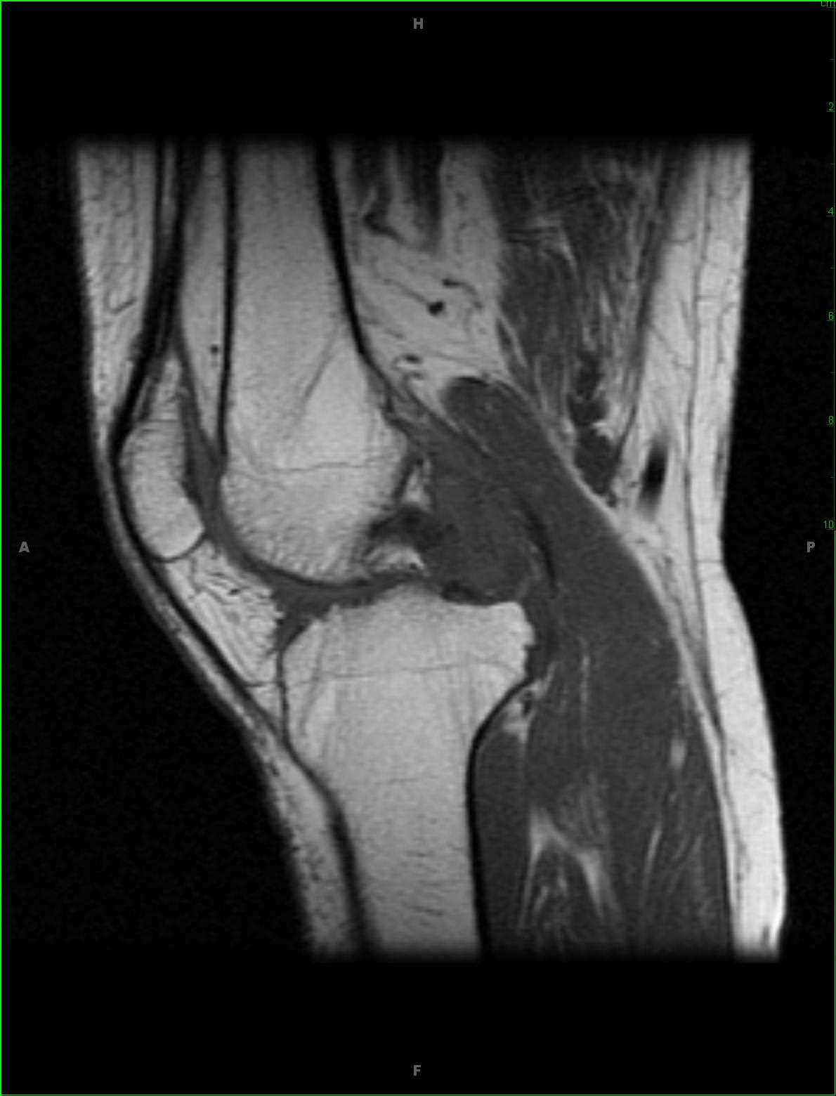 Pigmented Villonodular Synovitis Knee - CTisus CT Scan