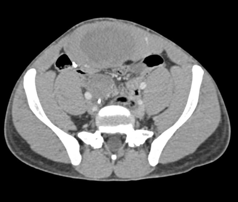 Desmoid Tumor in the Rectus Muscle - CTisus CT Scan