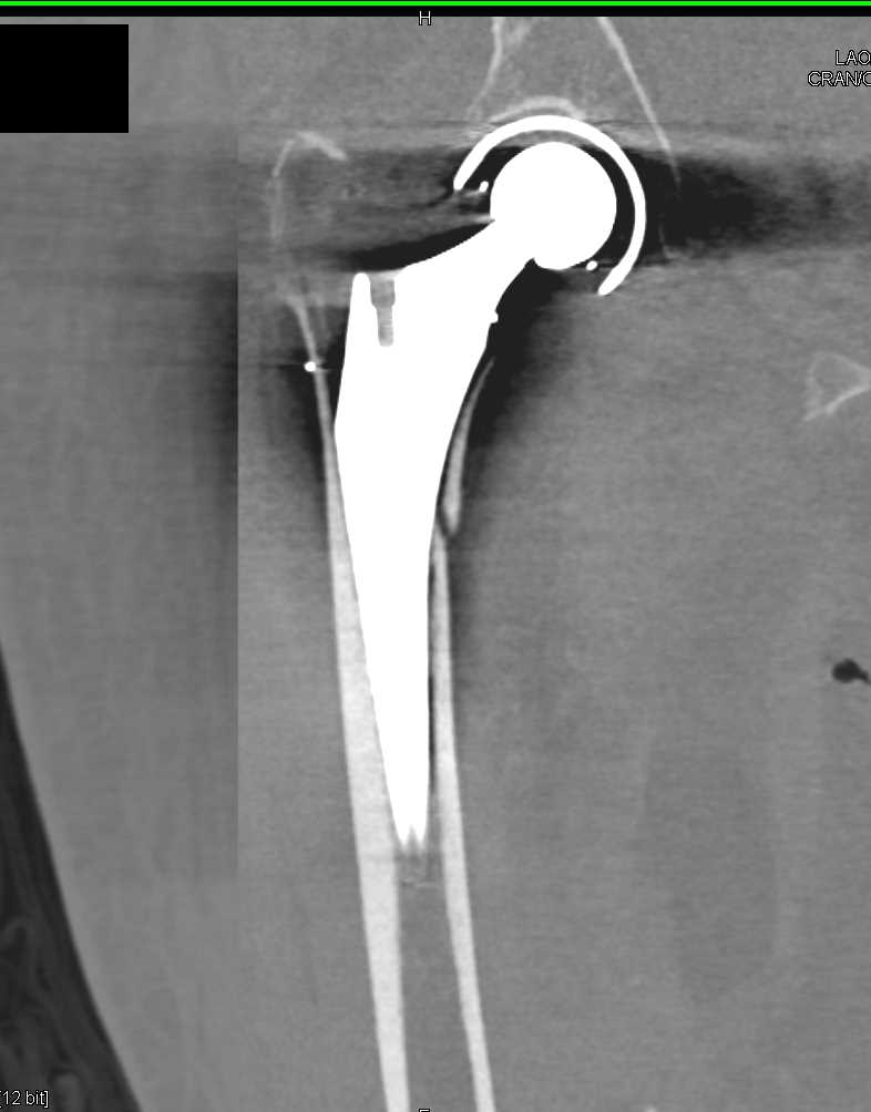 Fracture Femur Near Total Hip Replacement - CTisus CT Scan