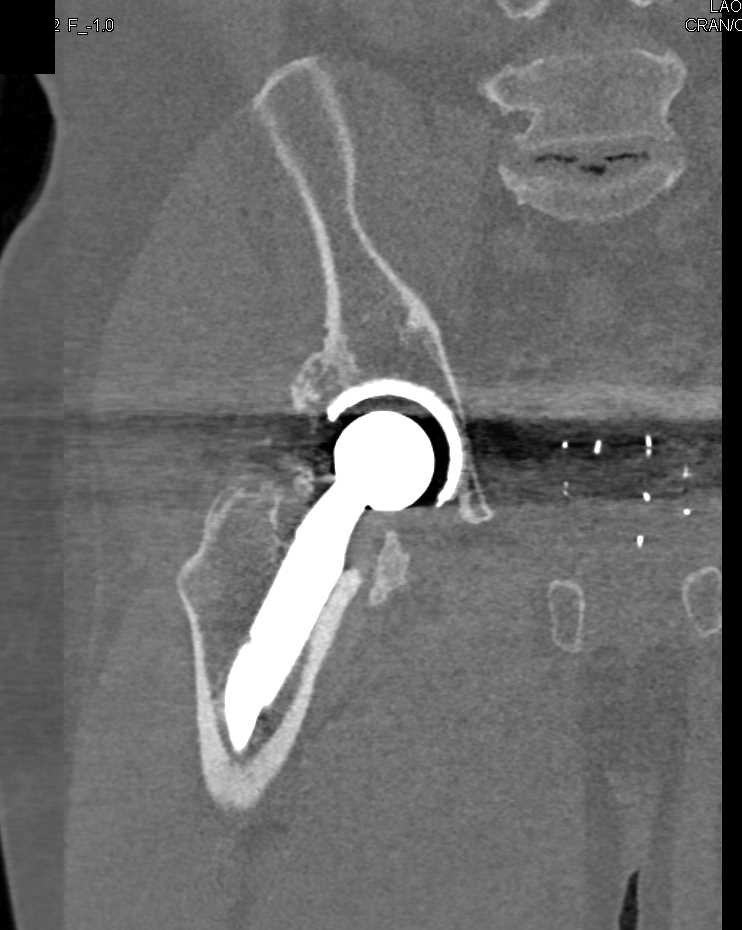 3D Map of a Hip Prosthesis - CTisus CT Scan