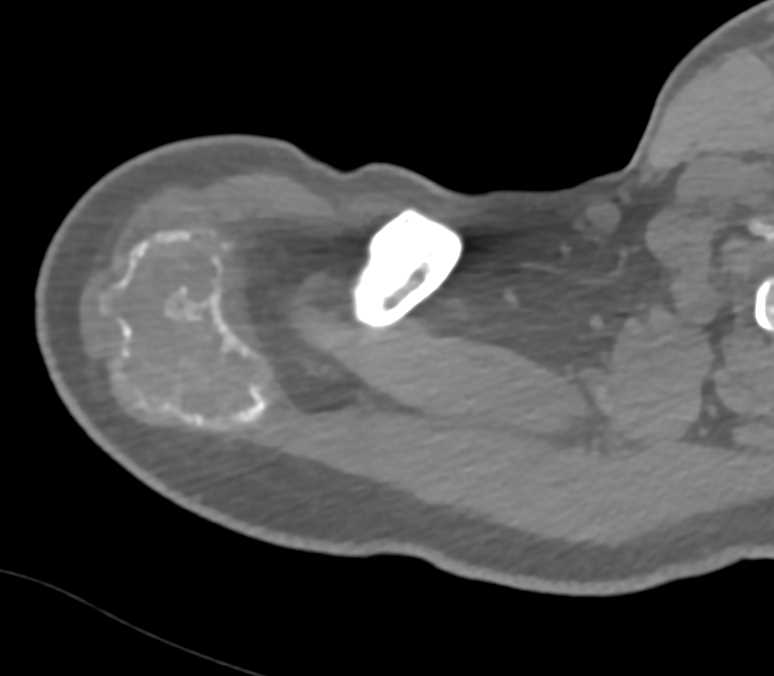 Aneurysmal Bone Cyst Of The Scapula Musculoskeletal Case Studies