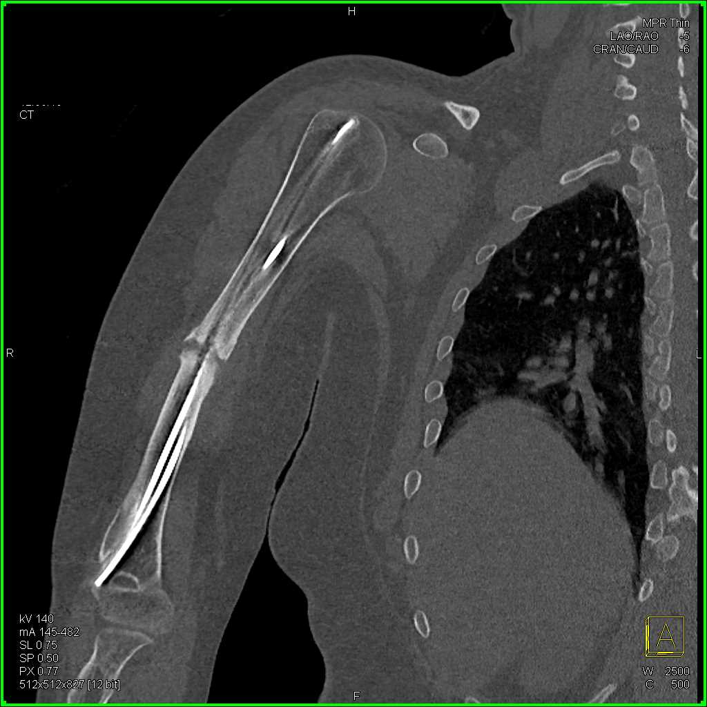 Nonunion of a Humerus Fracture - CTisus CT Scan