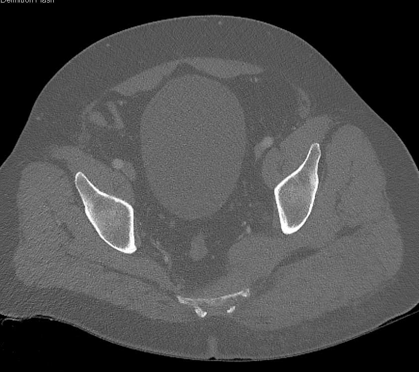 Left Gluteal and Piriformis Hematoma - CTisus CT Scan