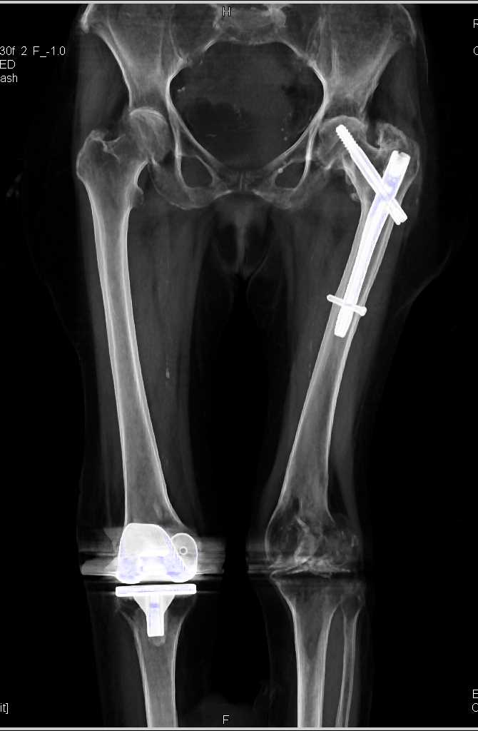 Left Distal Femur Fracture in Patient with Hardware - Musculoskeletal