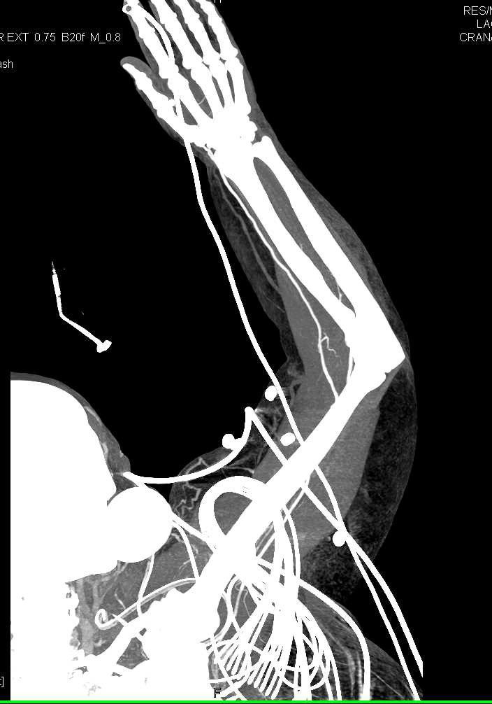 Normal CTA of the Upper Extremity - CTisus CT Scan