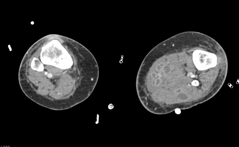 Multiple Bilateral Intramuscular Abscesses - CTisus CT Scan