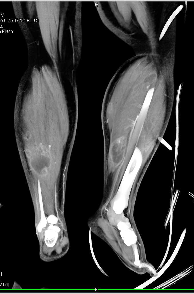 Multiple Bilateral Intramuscular Abscesses - CTisus CT Scan