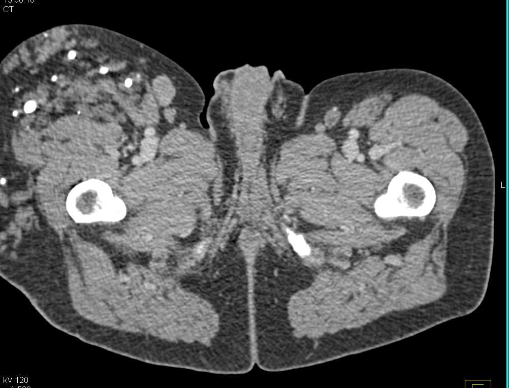 Hemangioma Right Thigh - CTisus CT Scan