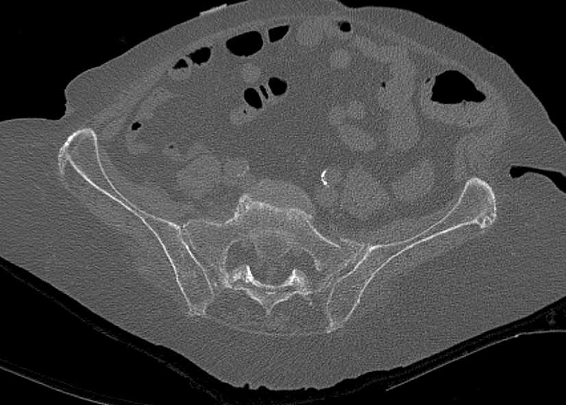 Sacral Insufficiency Fractures - CTisus CT Scan