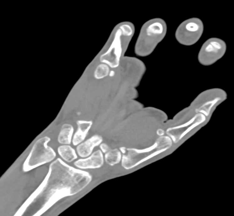 Fracture Base of the First Metatarsal - CTisus CT Scan