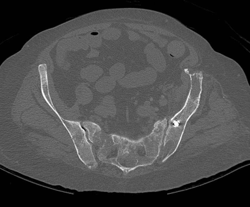 Multifocal Multiple Myeloma - CTisus CT Scan