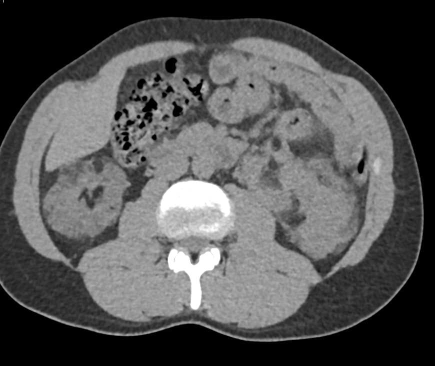 Multiple Bilateral Renal Angiomyolipomas (AMLs) and Osteomas Sacrum - CTisus CT Scan