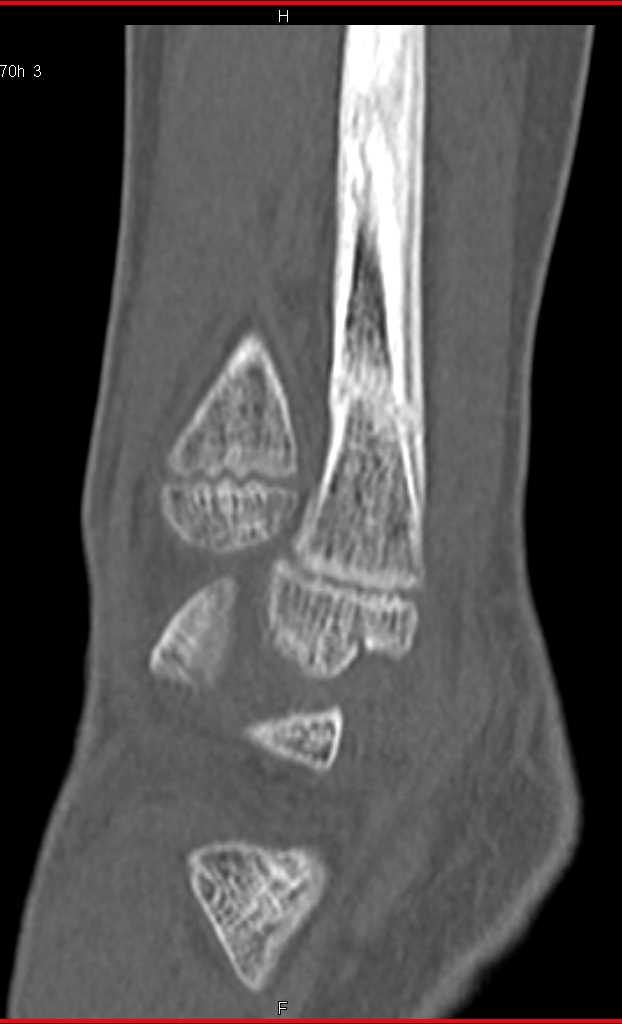 Healing Fractures Tibia and Fibula - CTisus CT Scan