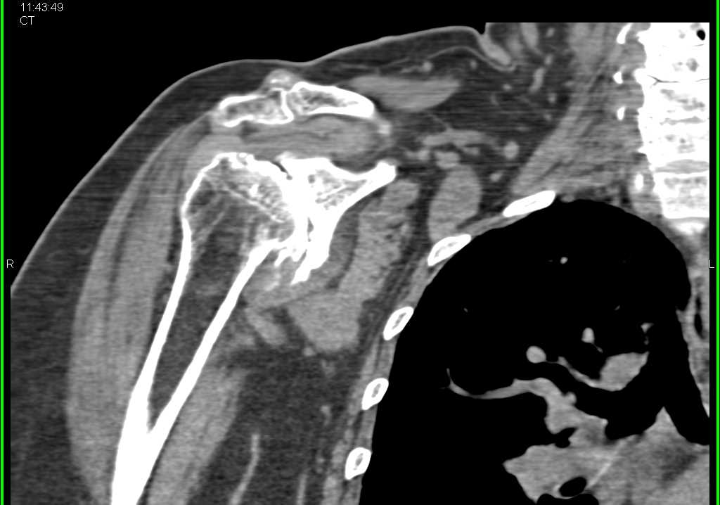 Severe Degenerative Joint Disease (DJD) Shoulder - Musculoskeletal Case ...