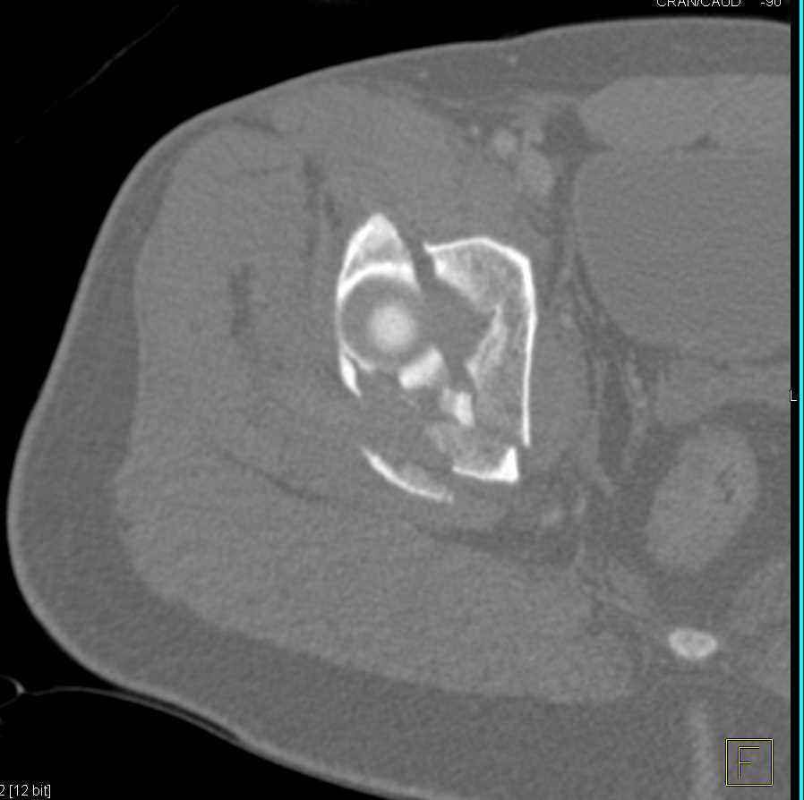 Comminuted Acetabular Fracture - CTisus CT Scan