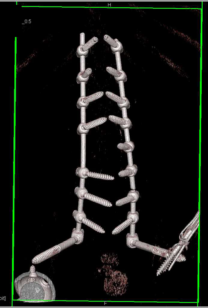 3D Rendering of Fractured Spinal Hardware - CTisus CT Scan