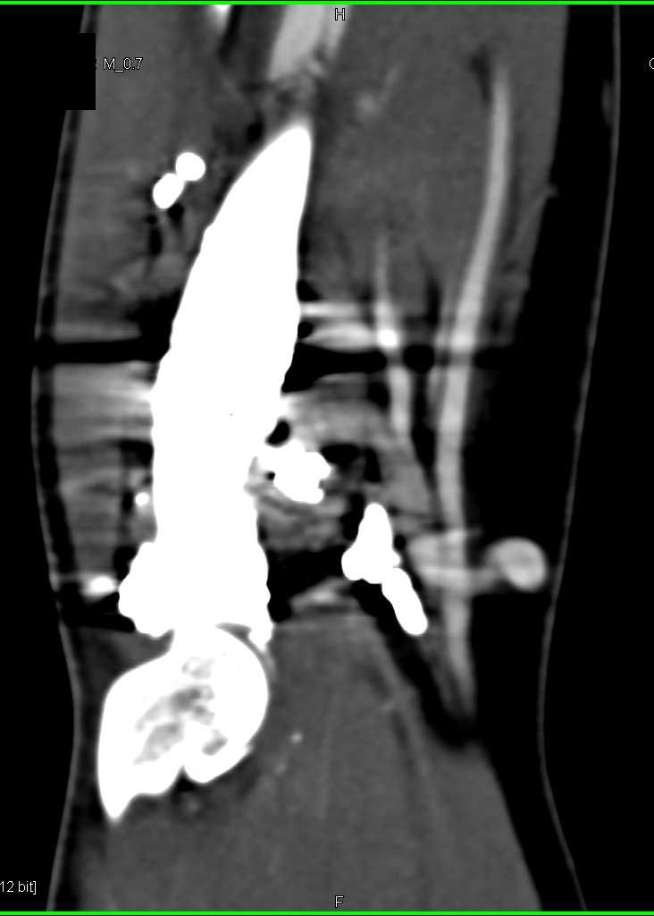 Prior Resection Radius - CTisus CT Scan