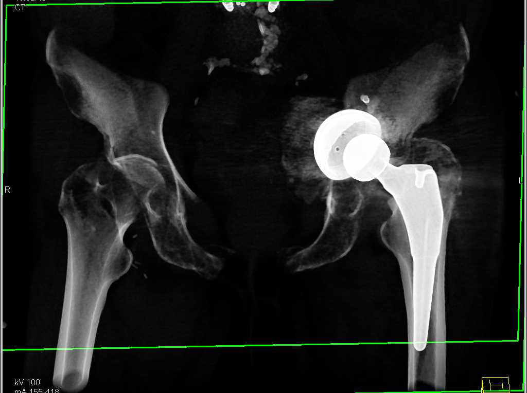 Loosening of a Left Total Hip Prosthesis - CTisus CT Scan