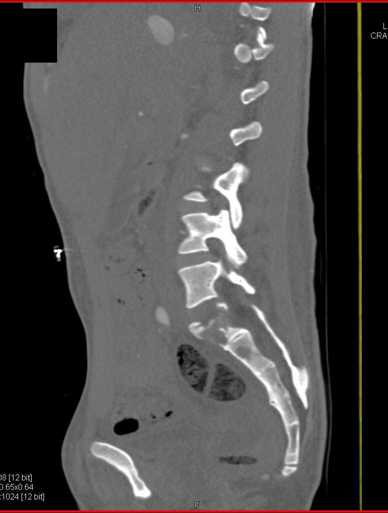 Giant Cell Tumor of the Sacrum - CTisus CT Scan