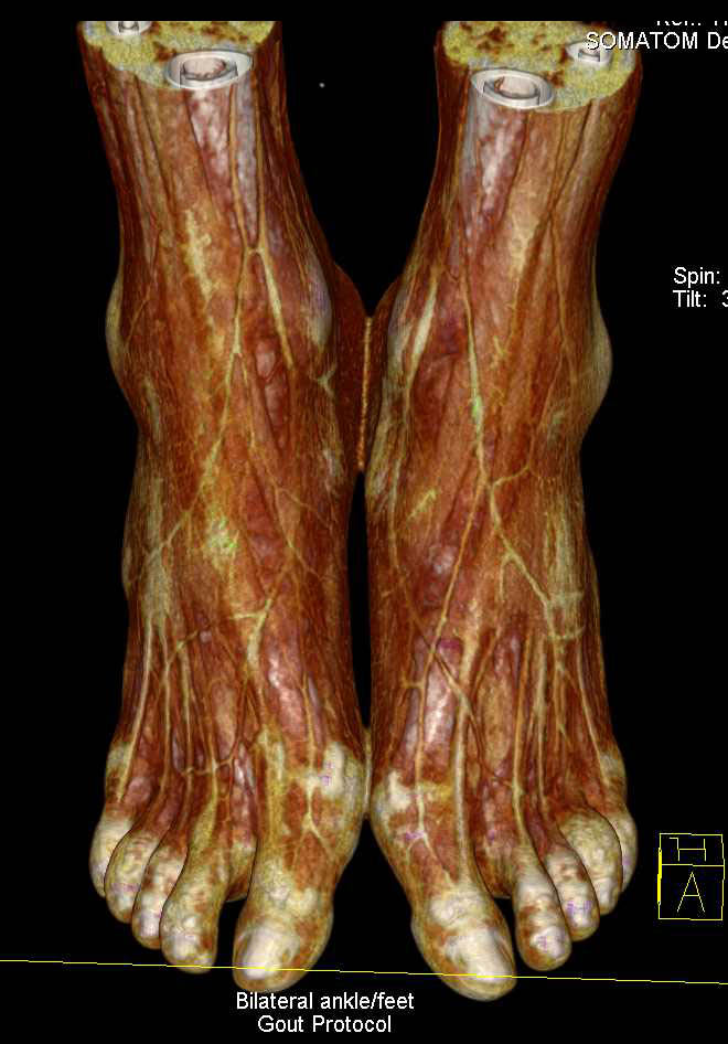 Dual Energy with Gout in Both Lower Extremities - CTisus CT Scan