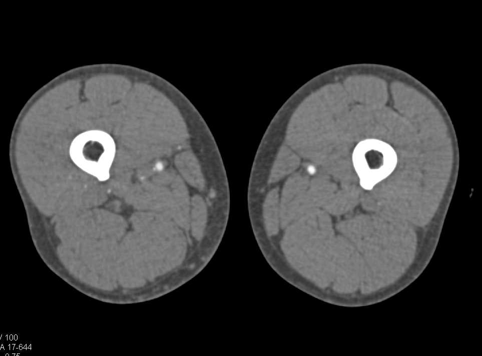 Osteomyelitis 2nd Digit Right Foot with Cellulitis and Early Venous Drainage - CTisus CT Scan