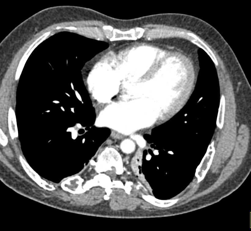 Fibrous Dysplasia Involving Multiple Bones with Expansile Lesions - CTisus CT Scan