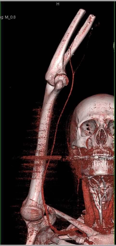 Preoperative Planning for Hand Transplant - CTisus CT Scan