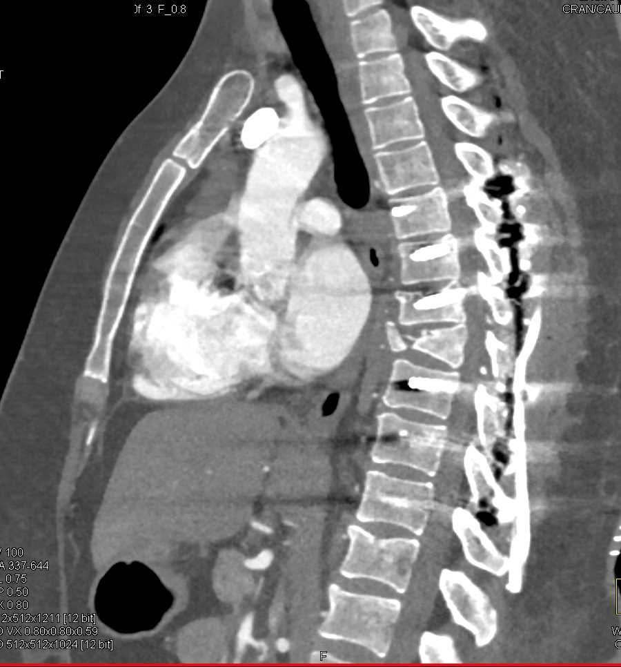 Spinal Fracture and Repair with Hardware - CTisus CT Scan