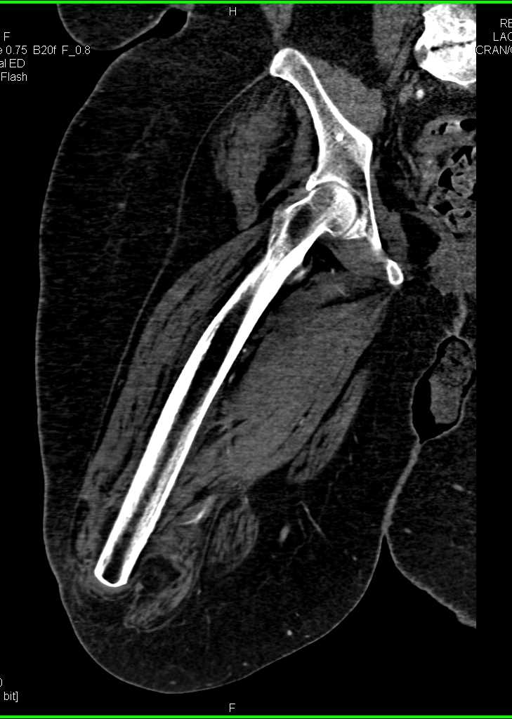 AKA (above-the-knee amputation) with Vascular Map of Stump - CTisus CT Scan