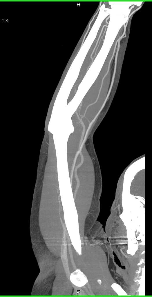 CTA Upper Extremity with Bone Removal to See Vascular Map - CTisus CT Scan