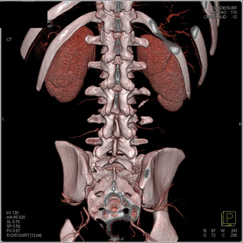3d Imaging Of The Lumbar Spine Musculoskeletal Case Studies Ctisus
