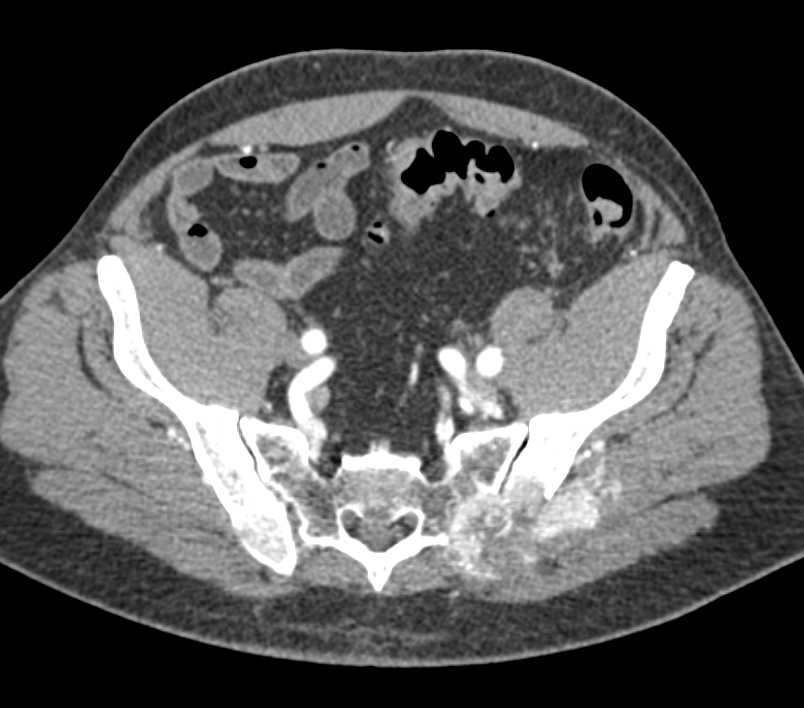 Metastatic Renal Cell Carcinoma to Left Iliac Wing - CTisus CT Scan