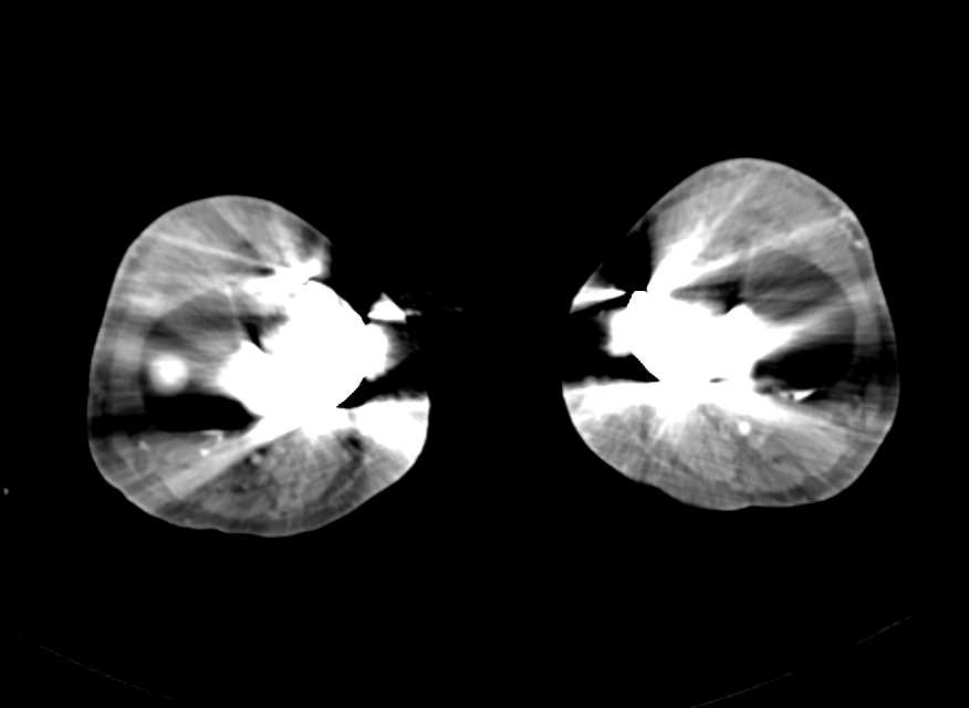 Limitations of CTA Runoff in Patient with Bilateral Total Knee Replacements - CTisus CT Scan