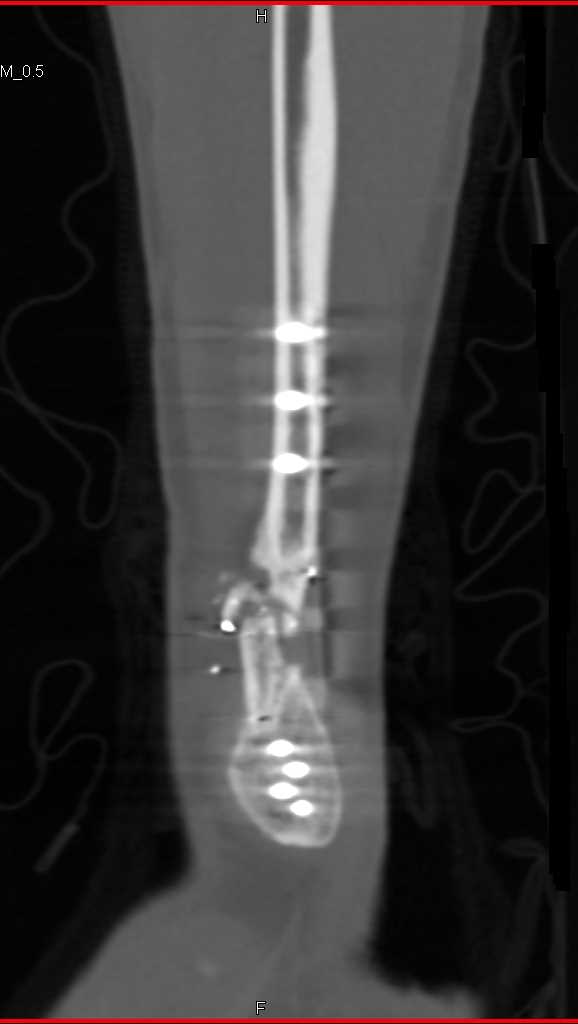 Fracture with Hardware in Place - CTisus CT Scan