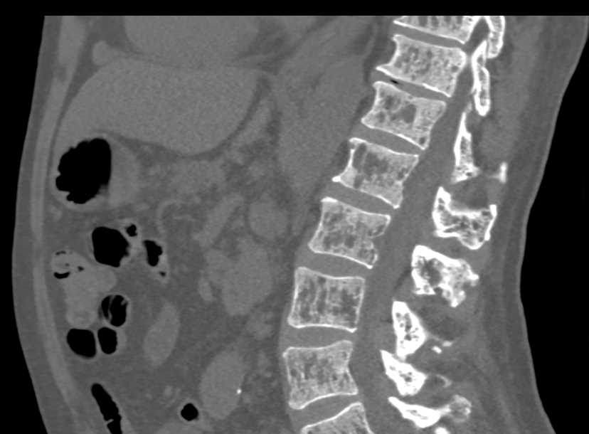 Multiple Bony Lesions due to Sickle Cell Disease - CTisus CT Scan