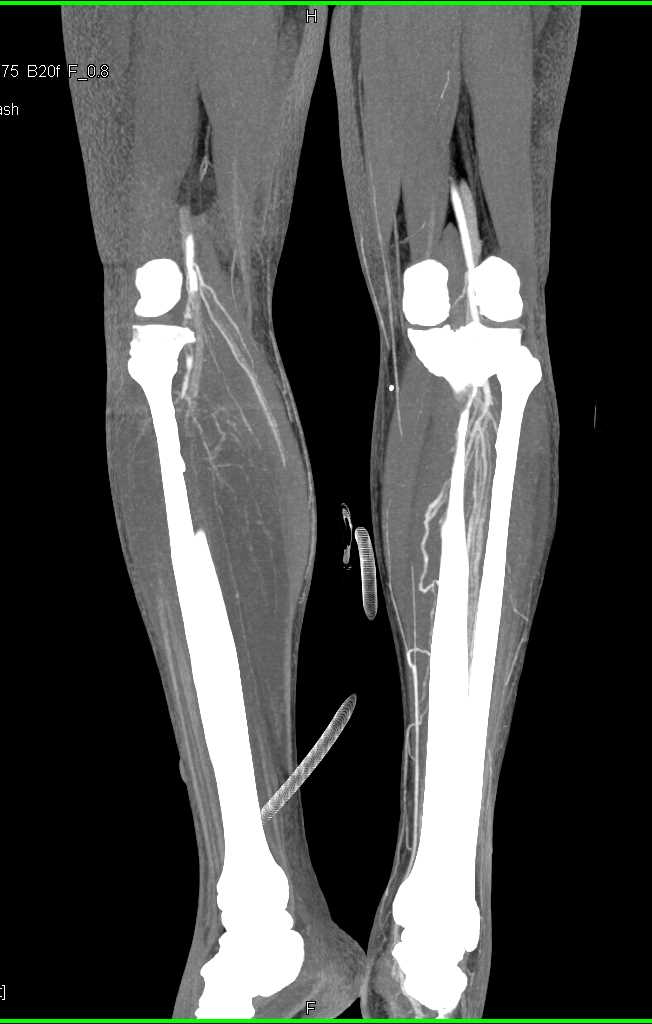 Myositis Right Calf with Decreased Muscle Enhancement - CTisus CT Scan