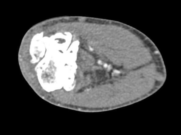 Degenerative Changes Elbow with Joint Space Narrowing - CTisus CT Scan