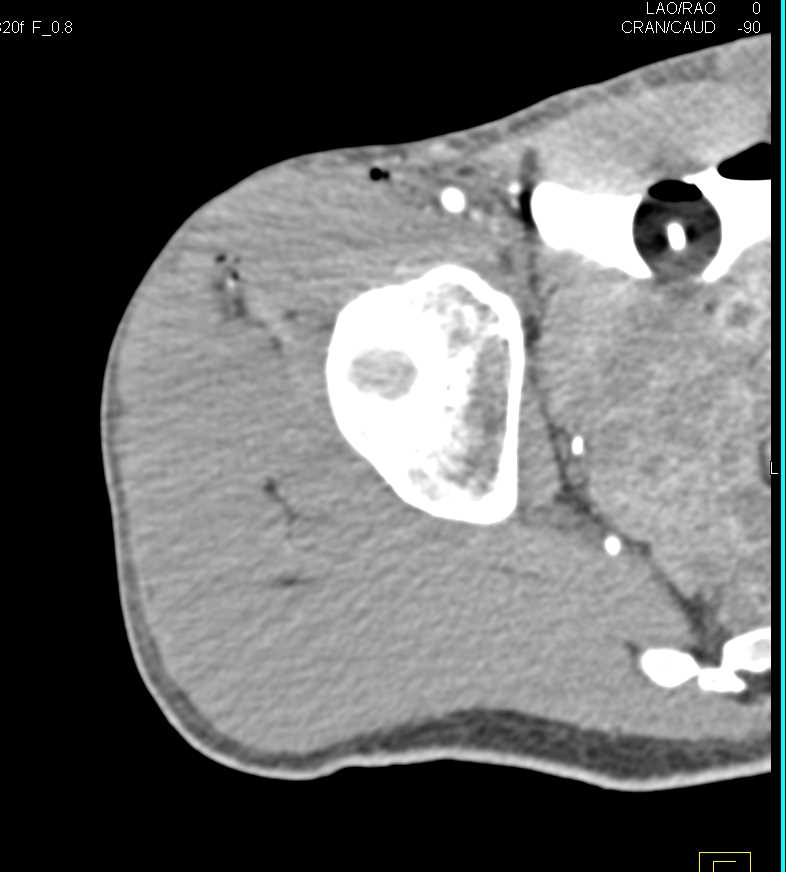 GSW Thigh with Femur Fracture - CTisus CT Scan